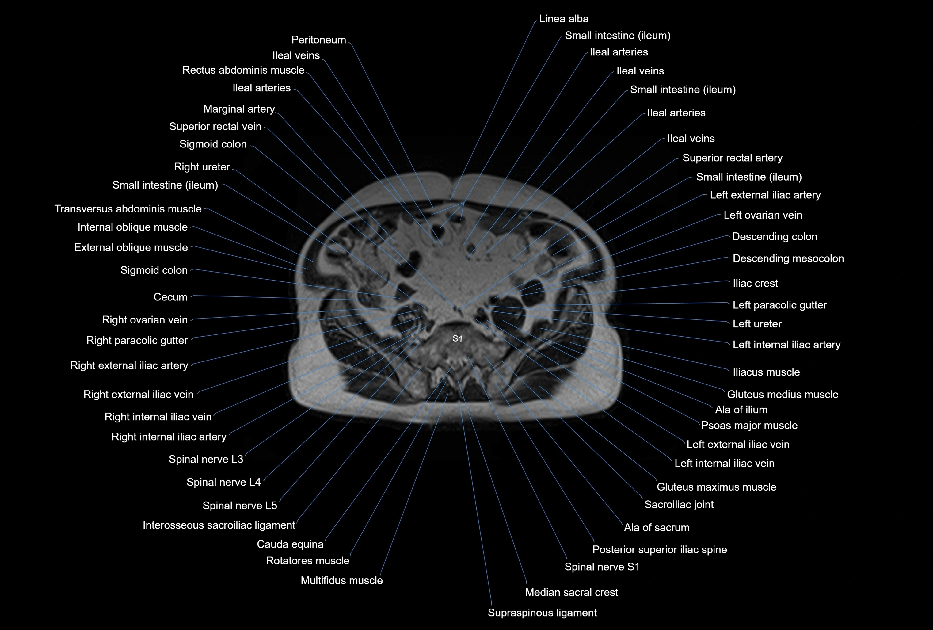 MRI Abdomen axial cross sectional anatomy radiology  image-img-00001-00040.webp